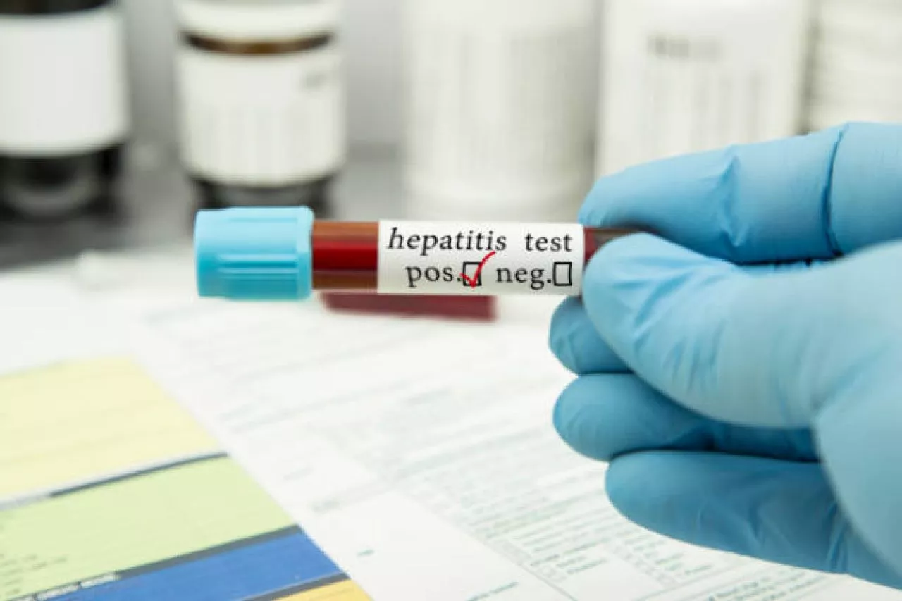 Kasus Hepatitis Misterius Mencuat, Dinkes Jatim: Tetap Tenang