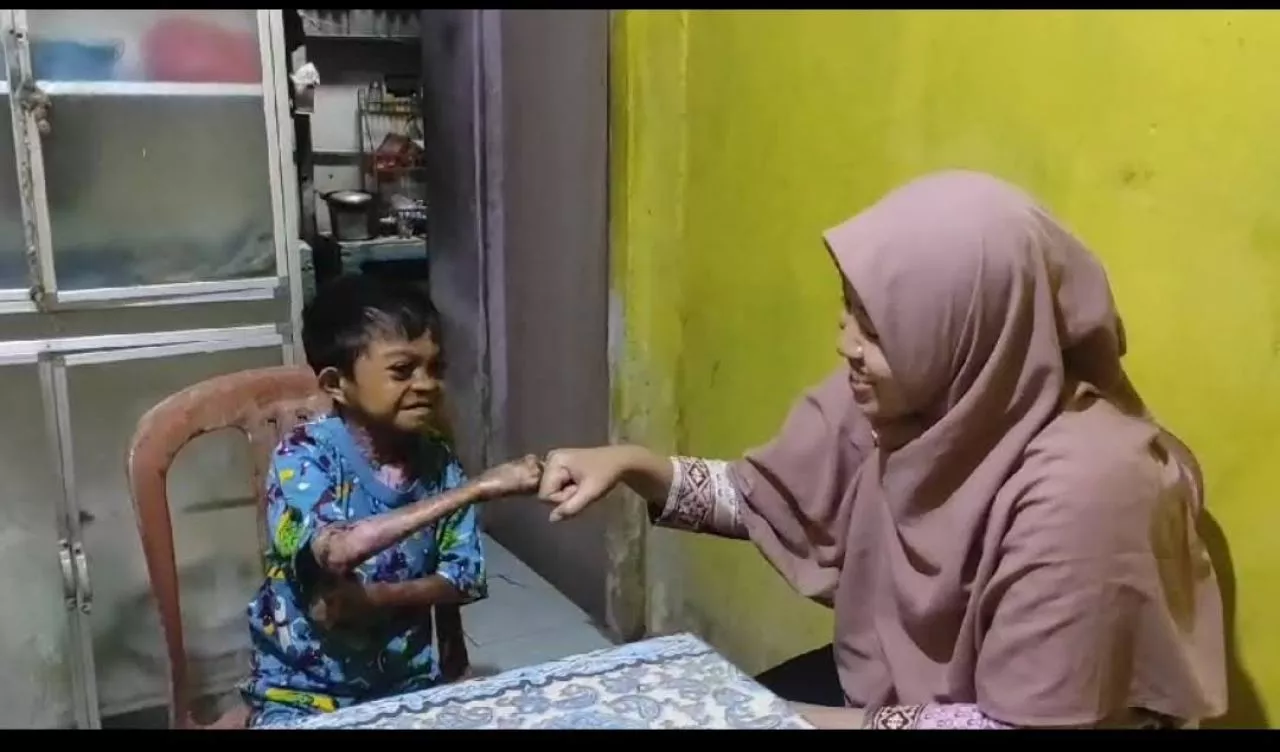 Kemensos Bantu Pengobatan Penderita Dermolisis Bulosa di Kendari